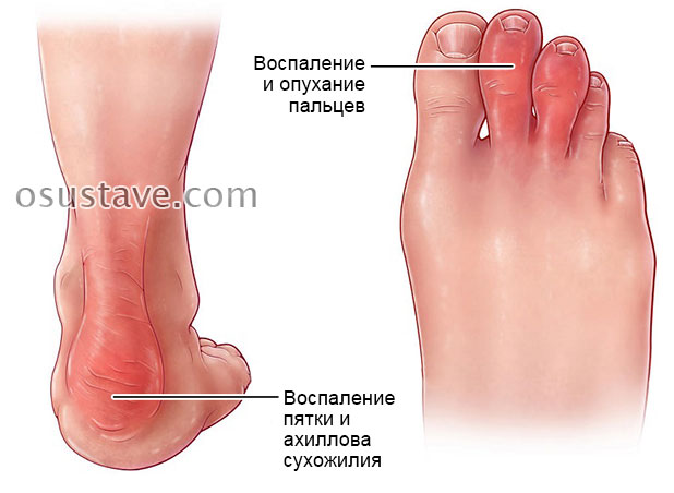 Тендинит стопы (голеностопного сустава