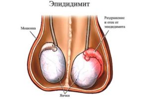 Пути передачи уреаплазмоза у мужчин и женщин, симптомы заболевания и можно ли инфицироваться бытовым путем