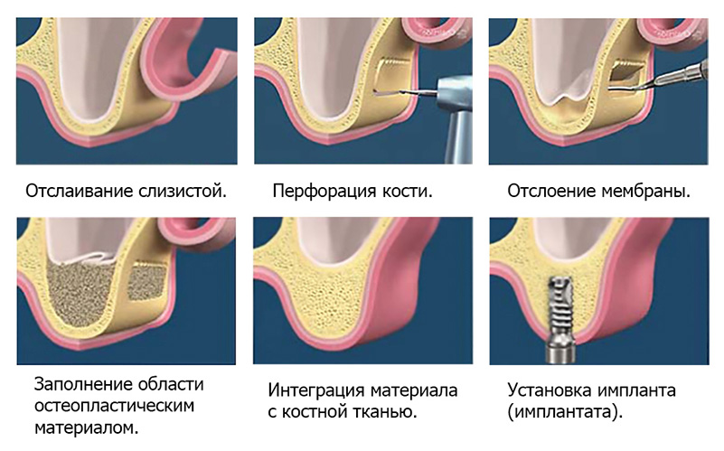 Этапы проведения синус-лифнига Этапы проведения синус-лифнига