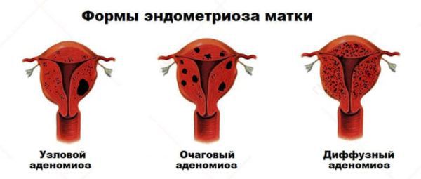 Аденоміоз: що це таке у жінок, симптоми, причини