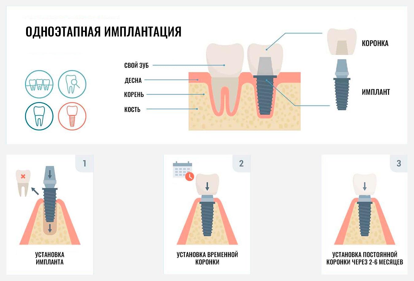 Одноэтапная имплантация зубов в Киеве: от чего зависит цена?