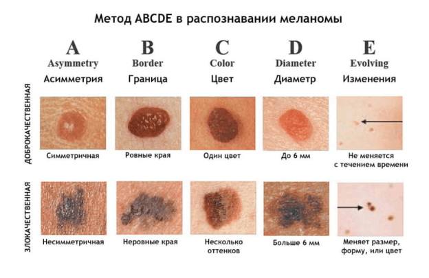 Лечение рака кожи в Израиле