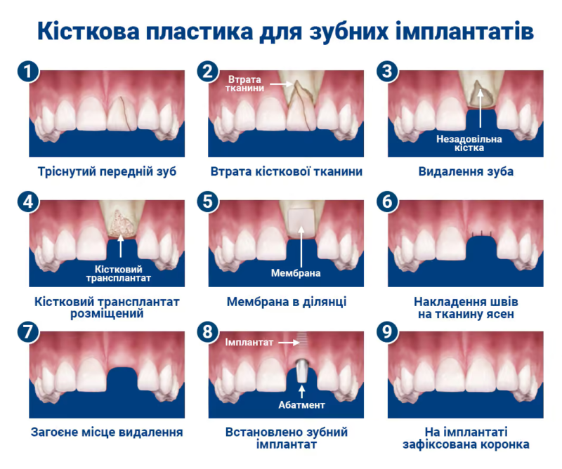 Сучасне протезування зубів