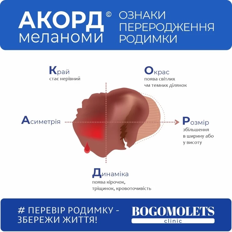 Родимки