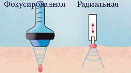 Фокусована і радіальна ударно хвильова терапія