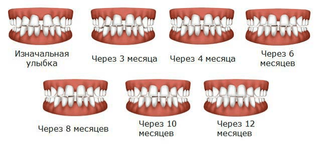 Сколько носят брекеты: все, что нужно знать