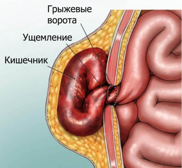 Чем опасна паховая грыжа, почему нельзя откладывать лечение