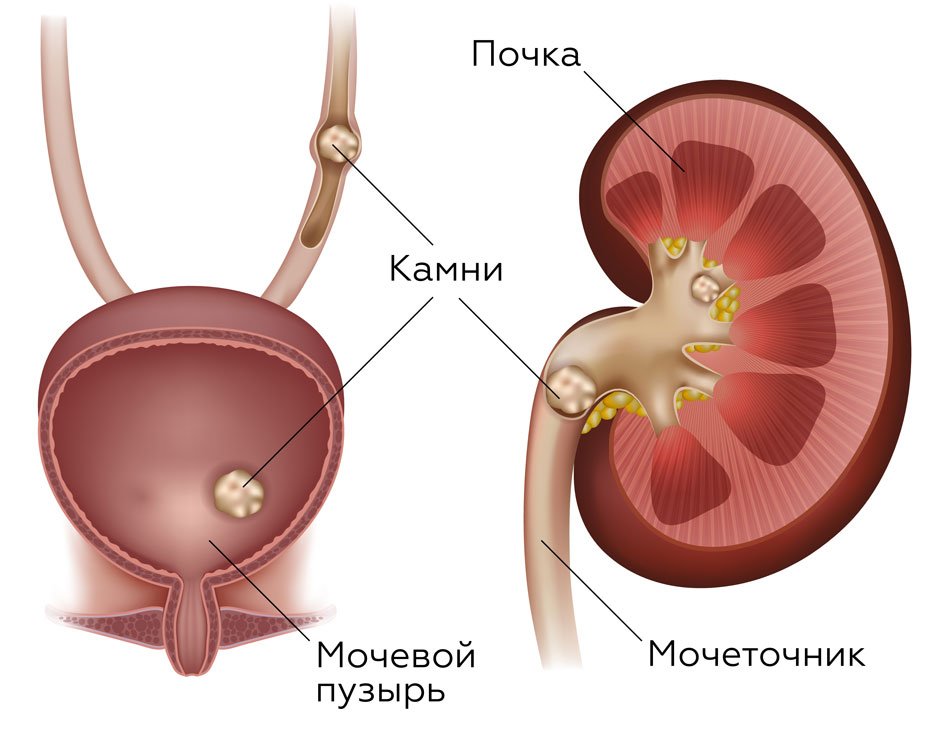 Мікролітіаз нирок